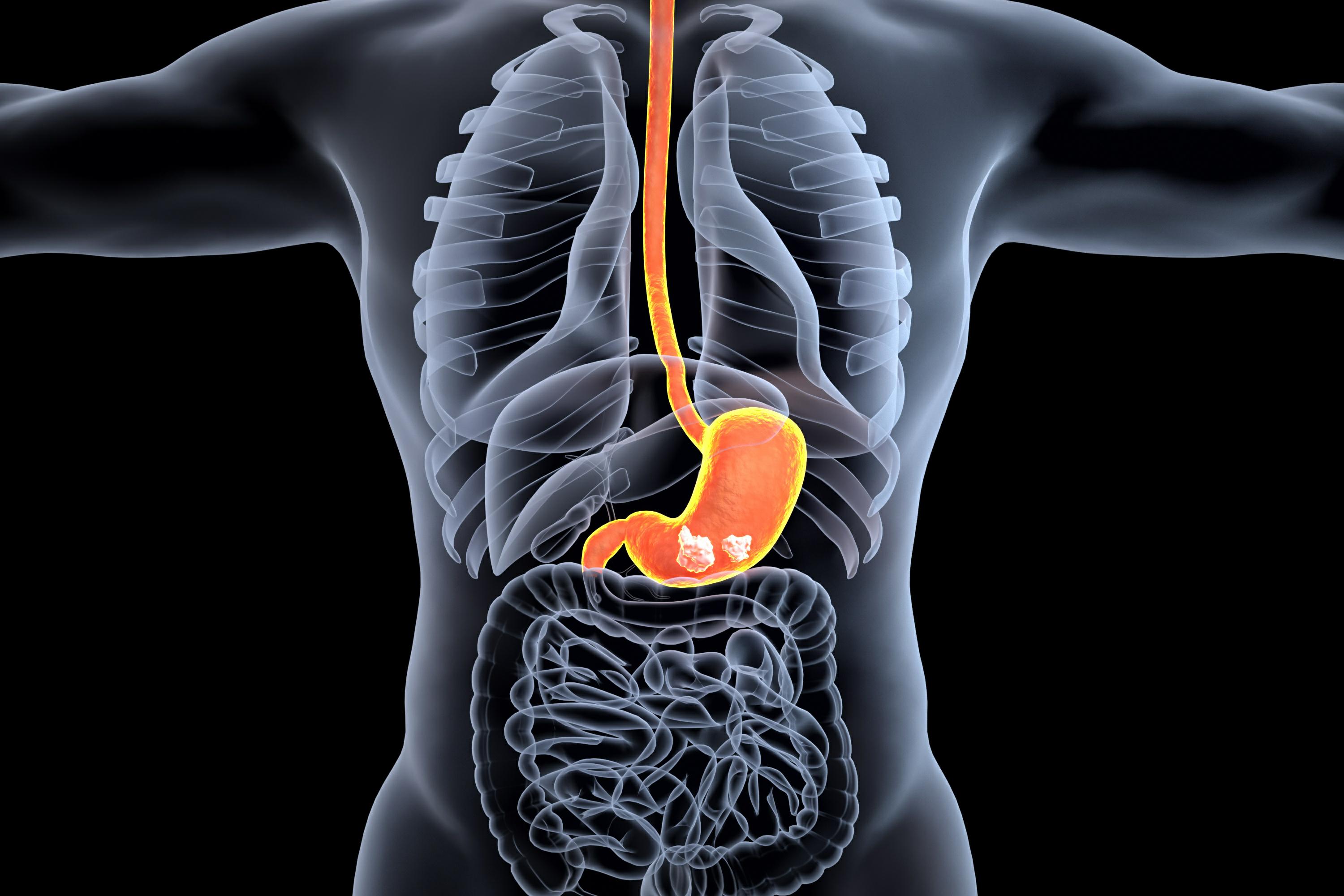 Advanced gastric cancer with metastasis, fortunately, I chose ...