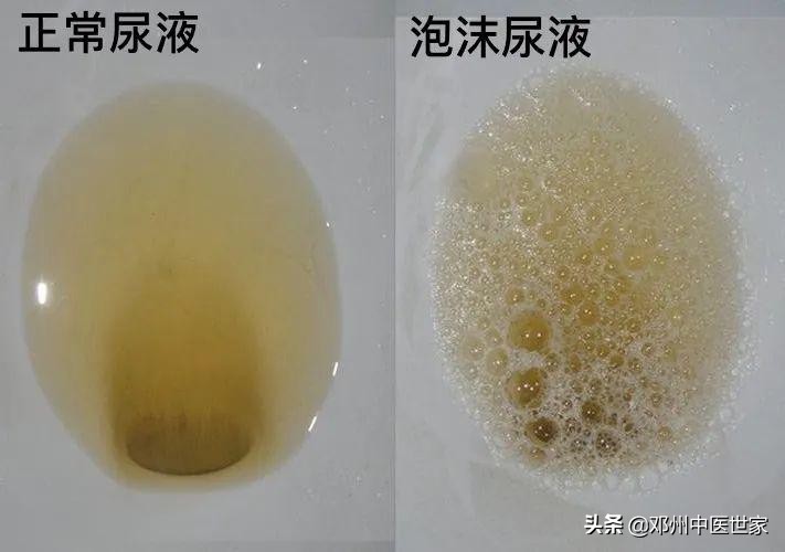 What is the reason for the foamy urine when urinating? - iNEWS