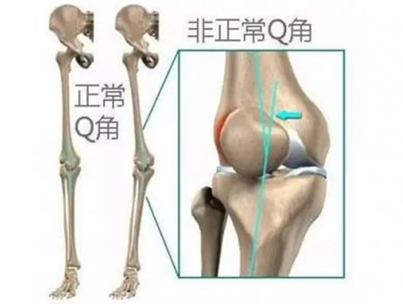 Q angle theory and its clinical significance iNEWS