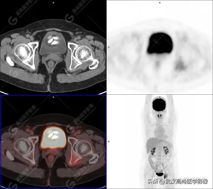 Two cases of plasmacytoma detected by PET/CT 