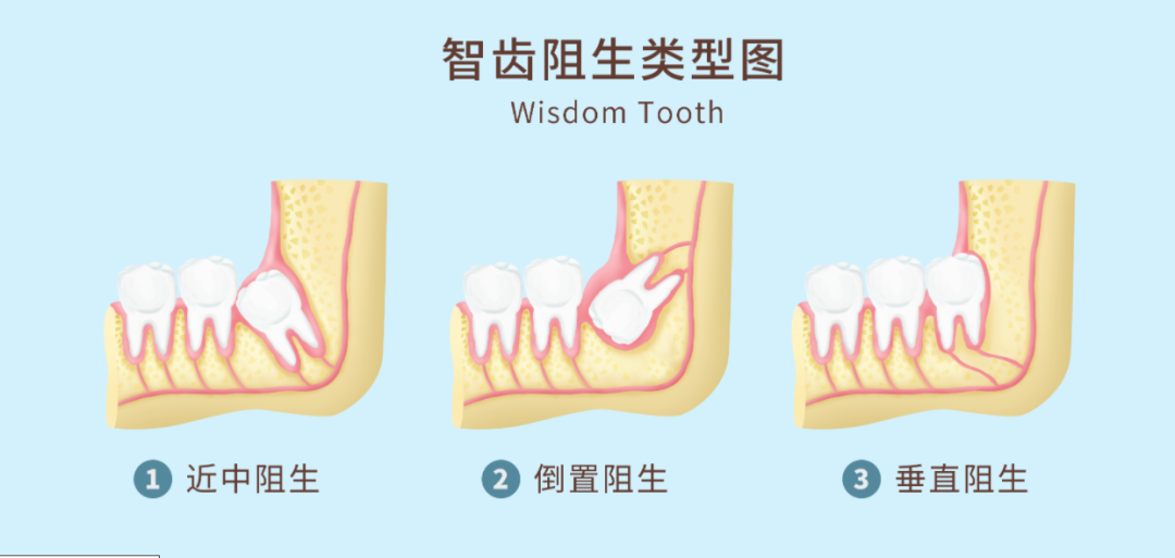 After so many years, do wisdom teeth have to be extracted?There are 4