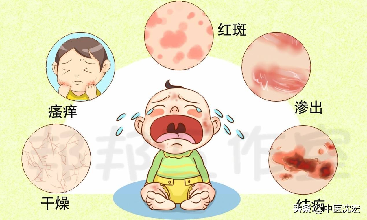 5 Chinese herbs are wonderful for allergic eczema, hives, itchy skin