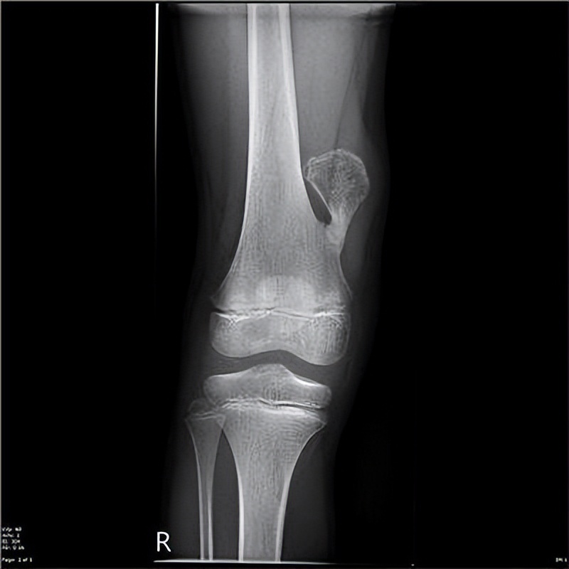 There is such a big difference between the two types of tumors!What is ...