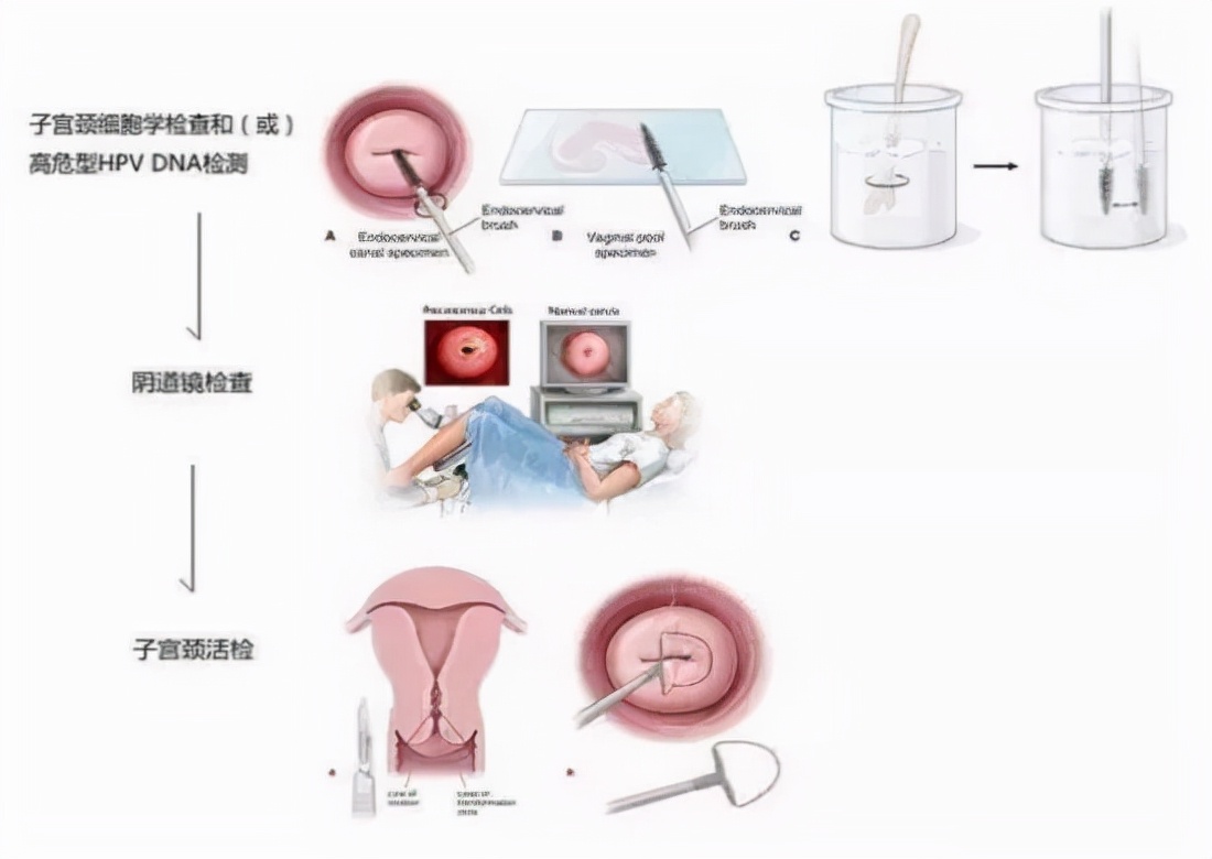 What should you pay attention to during colposcopy? - iNEWS