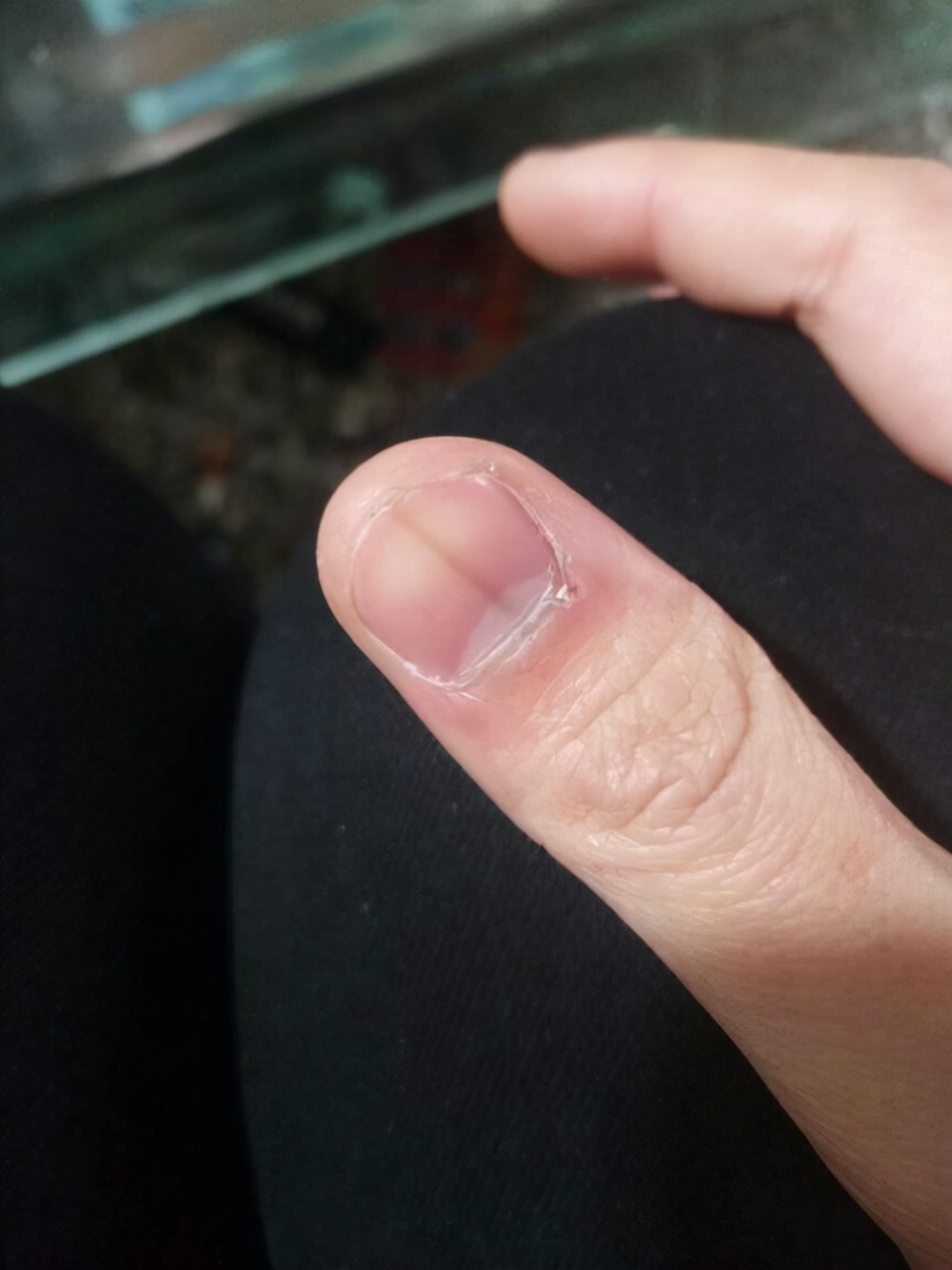 Why do fingernails have "vertical lines"?Several problems that often occur with nails, it is
