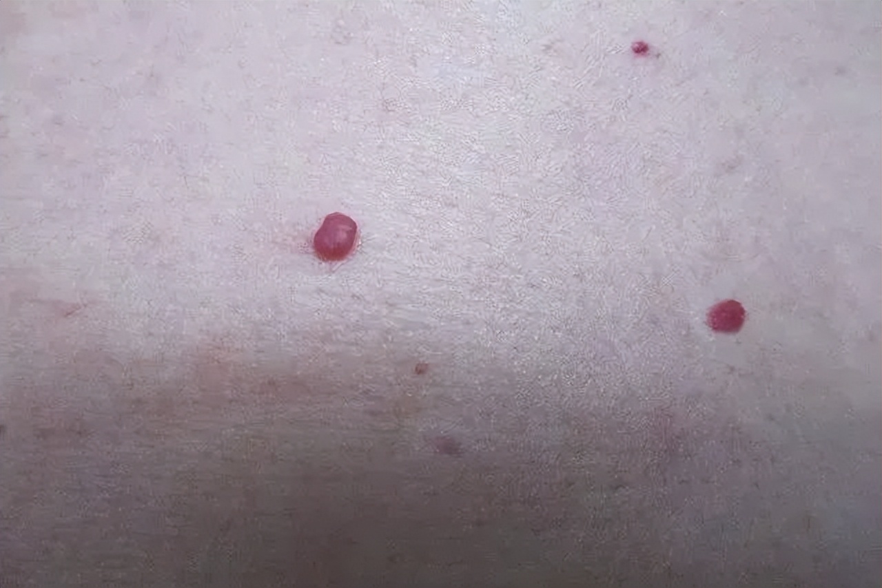 Blood Moles Appear On The Body Inexplicably, Be Careful!newborn Babies 