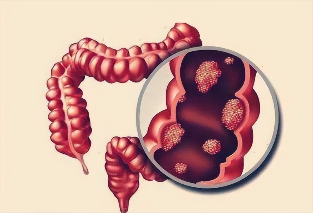 When I go to the toilet, the front of the stool is dry and hard, and