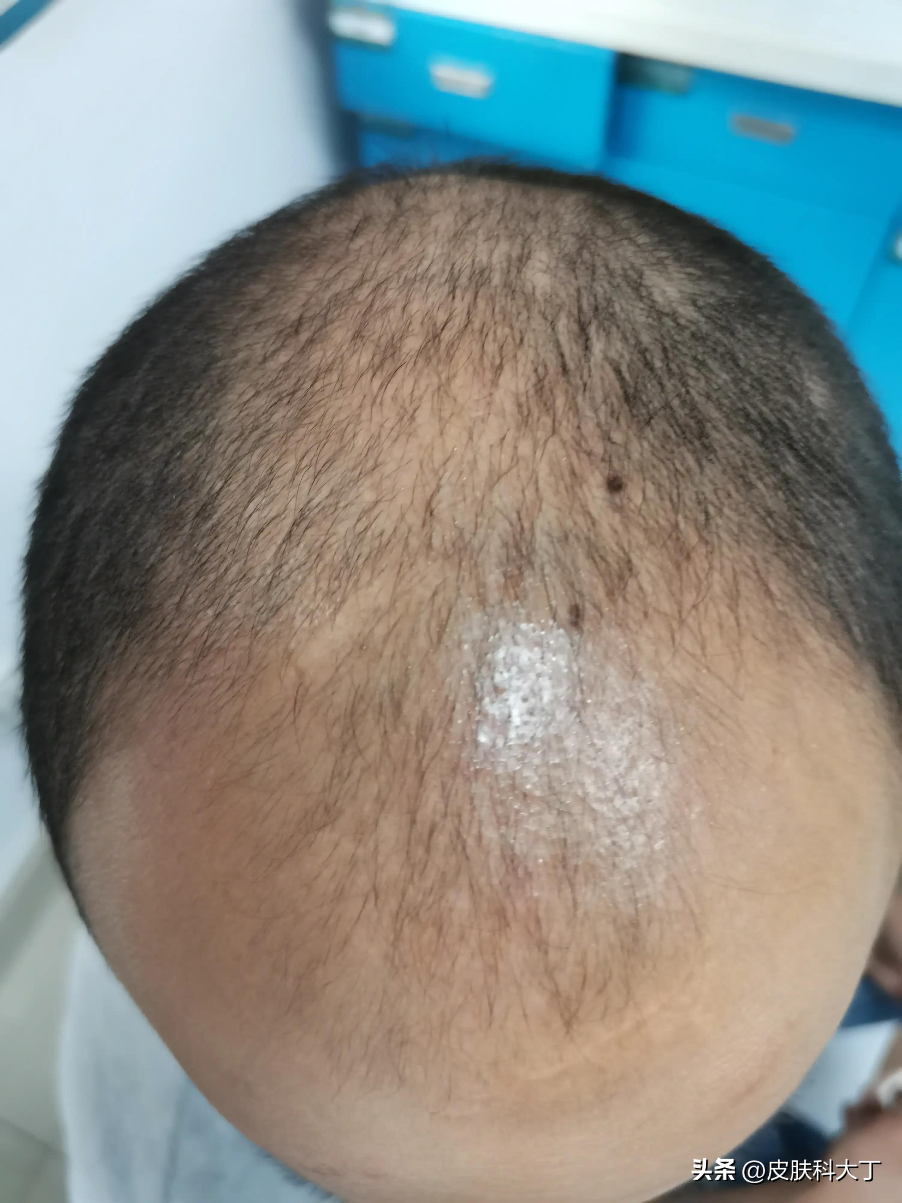 What type of hair loss do you have? iMedia