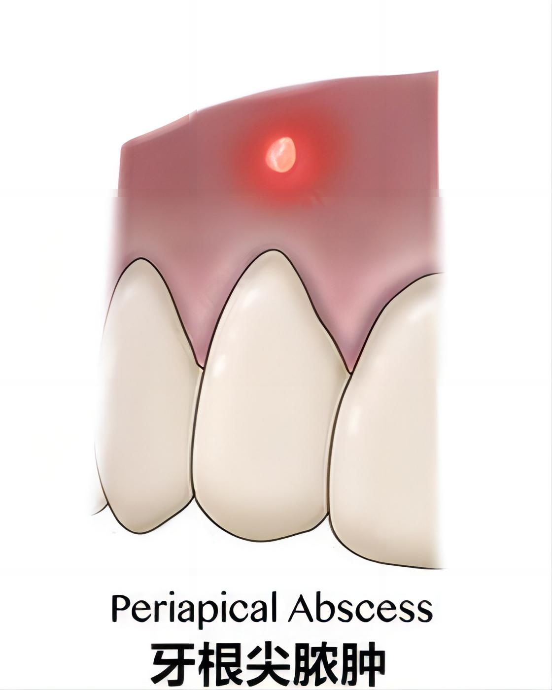 [Pulsive pustule on the gums] The pustule on the root of the tooth ...