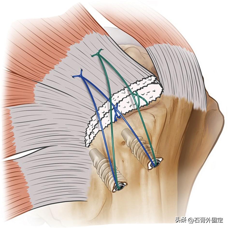 Key points and stages of rehabilitation management after arthroscopic