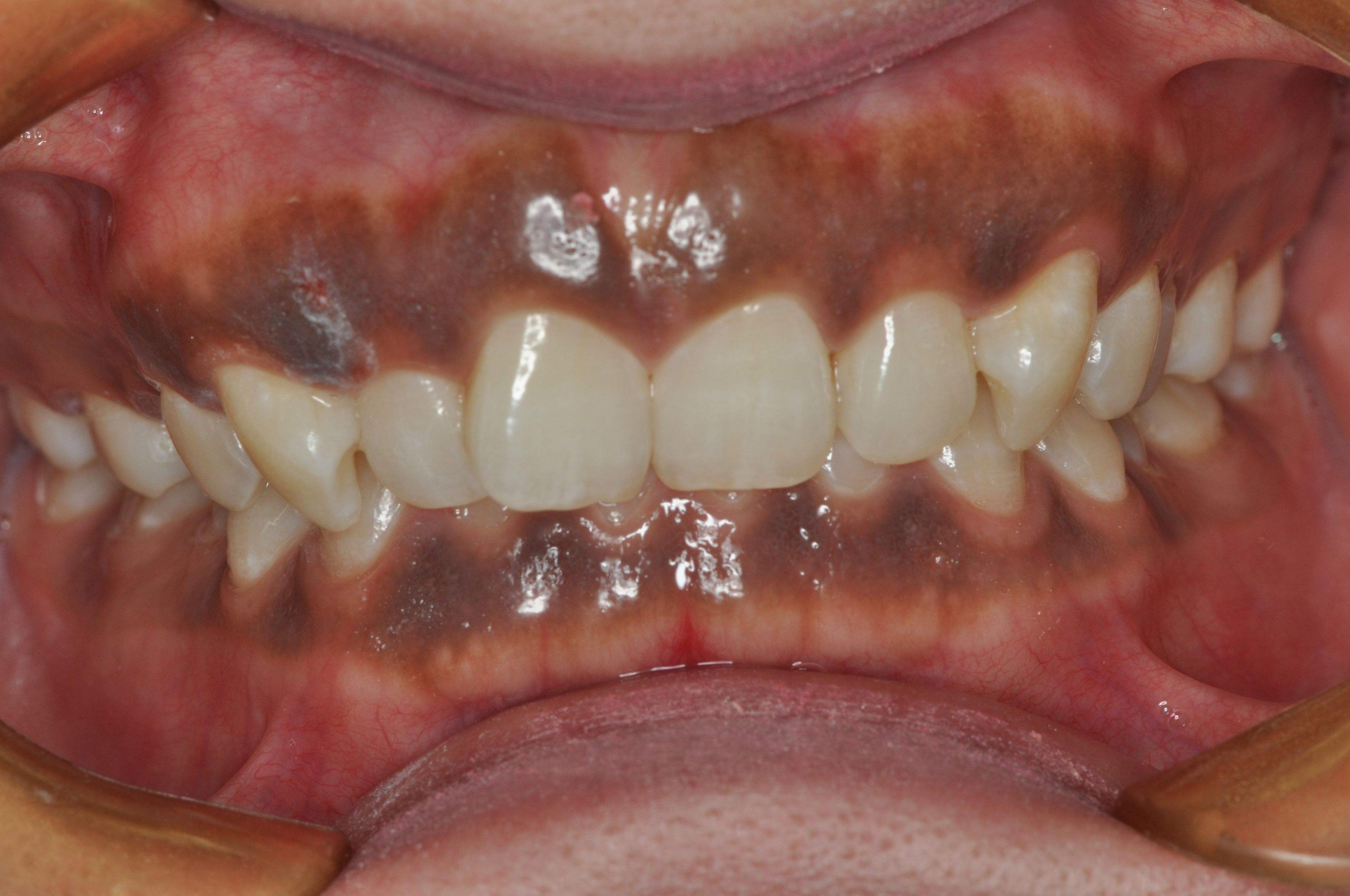 What Is The Disease Of Black Gums!Reminder: These Things Need To Be ...