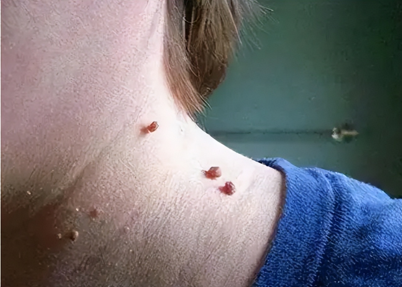 What are the "small meat particles" on the neck and armpit?Can you just