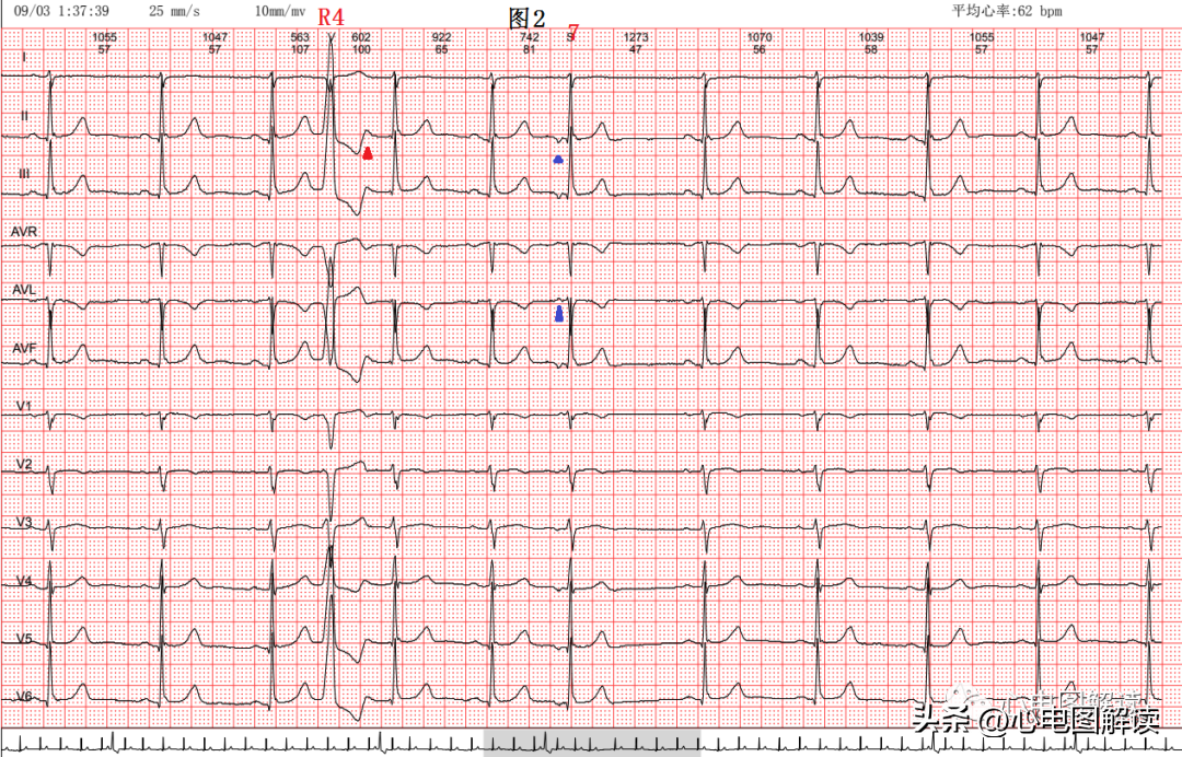 Premature ventricular contractions with fully compensated ...