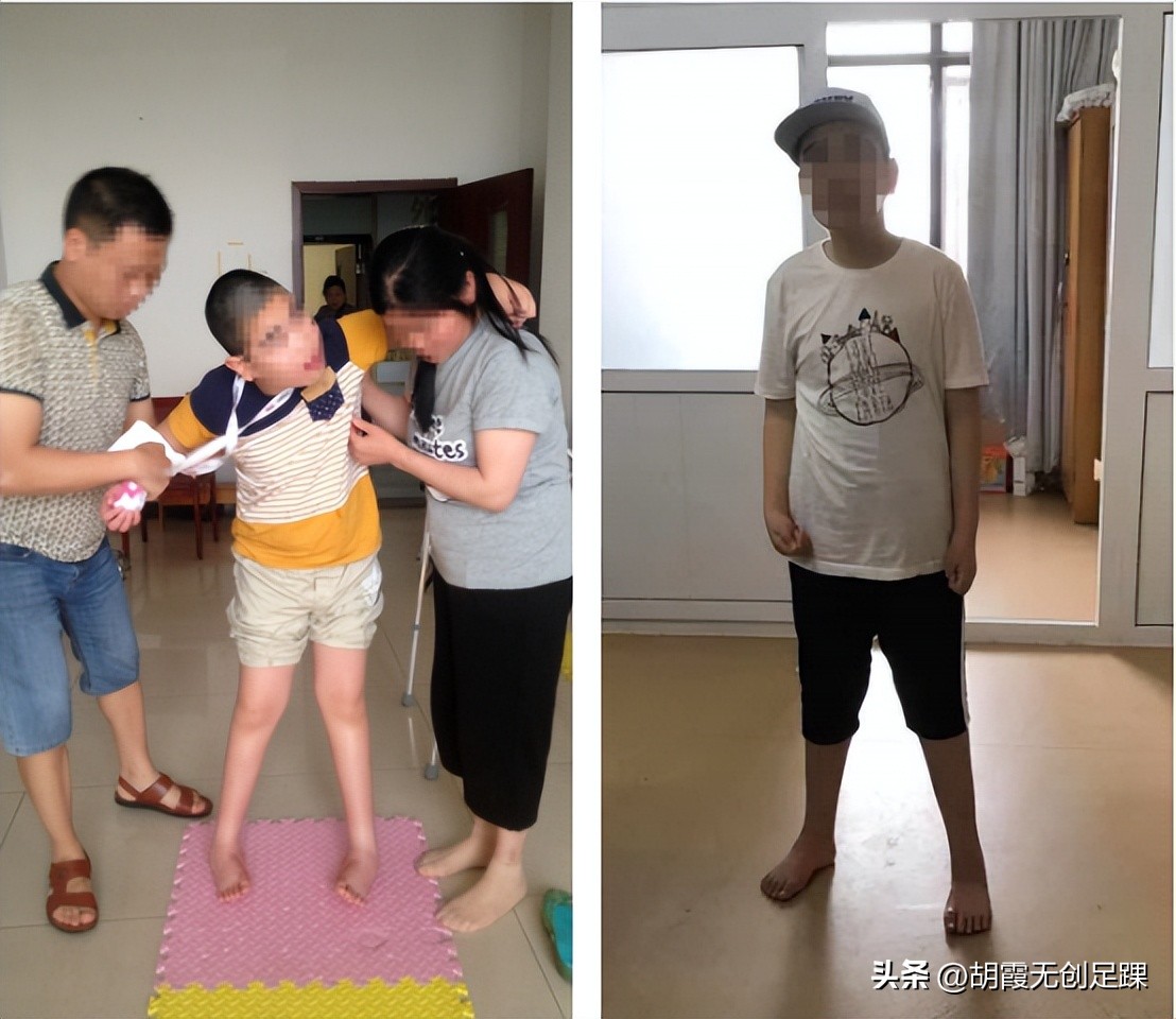 How is foot inversion in children with cerebral palsy treated? - iNEWS