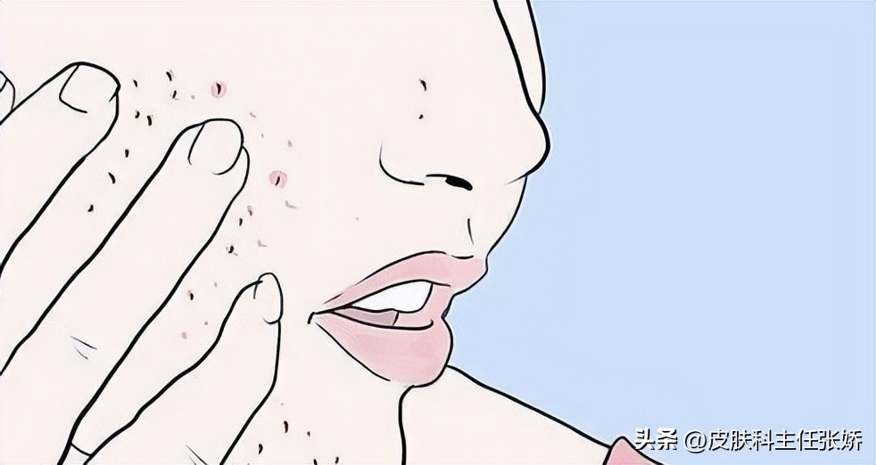 The Acne Is Cured What Should I Do If The Acne Marks Are Left INEWS