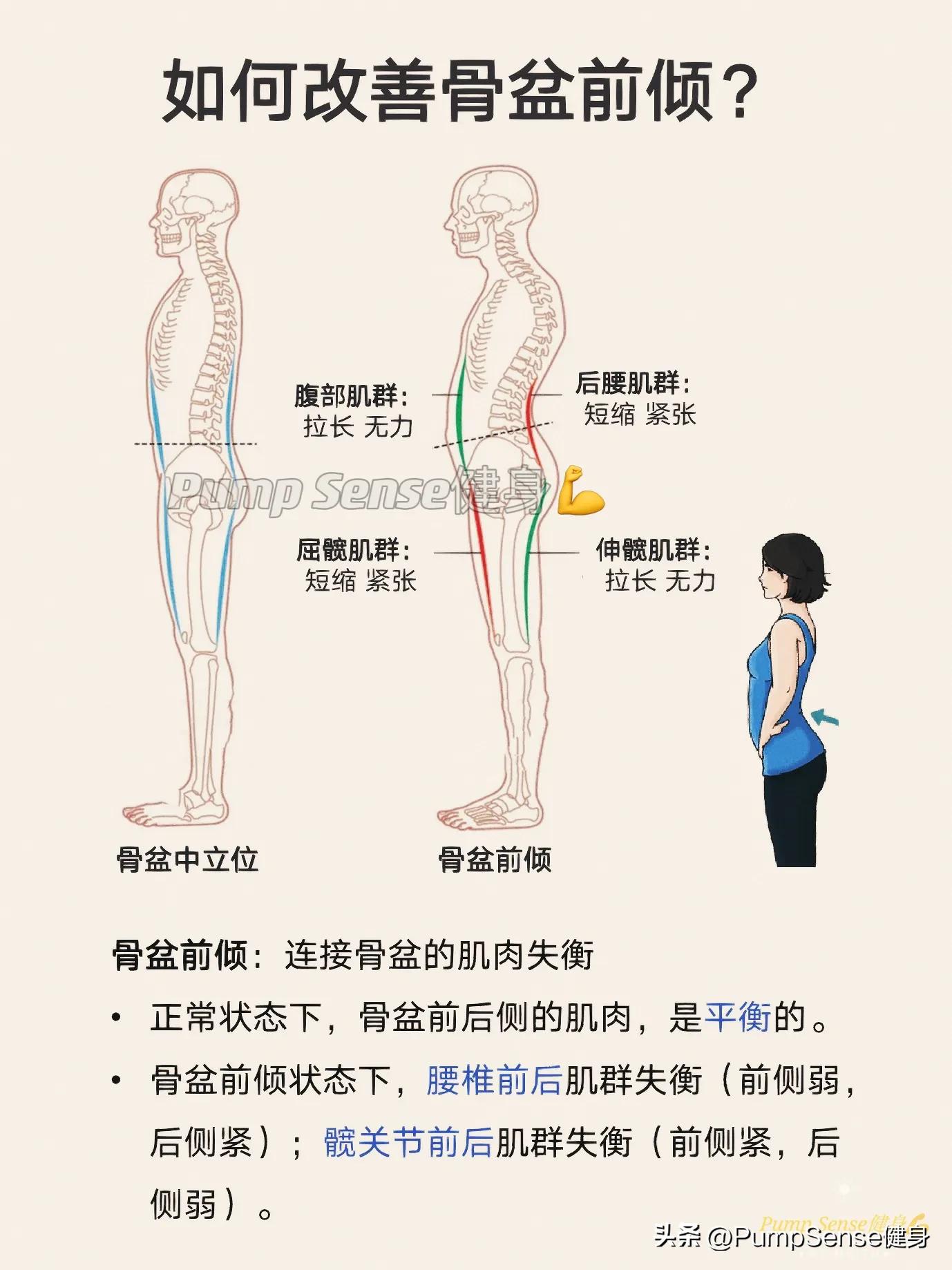 骨盆前傾怎麼改善，會有什麼危害？ - 資訊咖