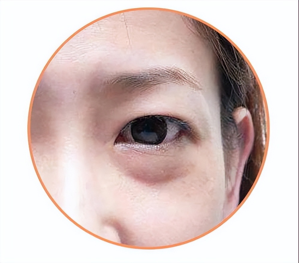 What is edematous eye bags?Are your eyes swollen after drinking water