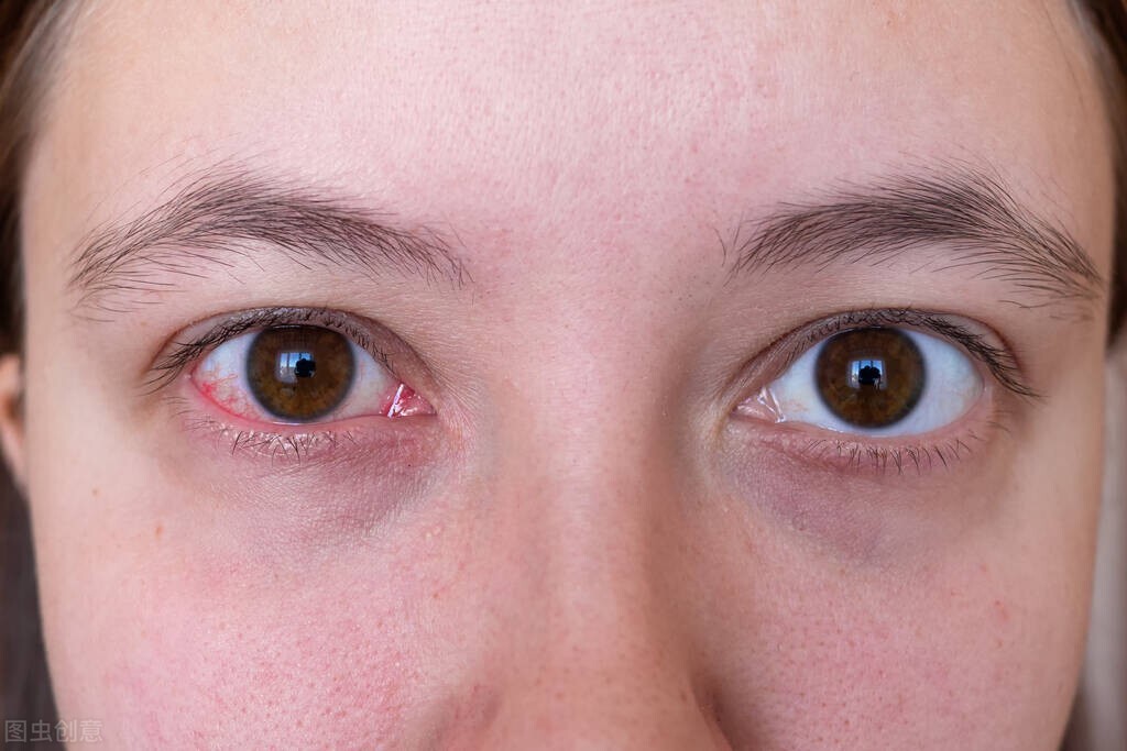 what-causes-red-blood-in-eyes-it-s-not-just-eyestrain-inews