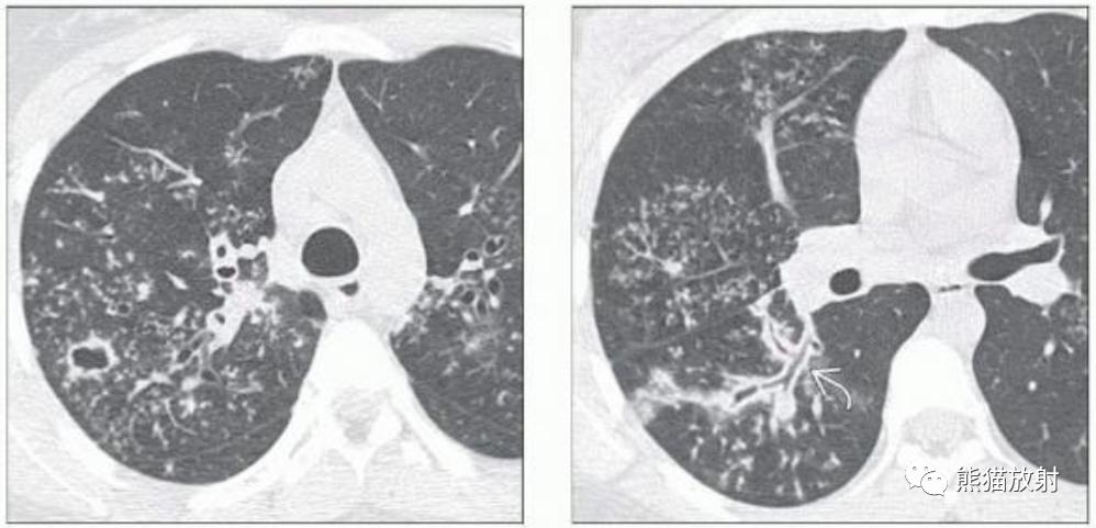 Tuberculosis, nontuberculous mycobacterial lung disease, mycoplasma ...