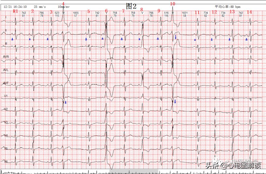 Nonsustained ventricular tachycardia, premature ventricular