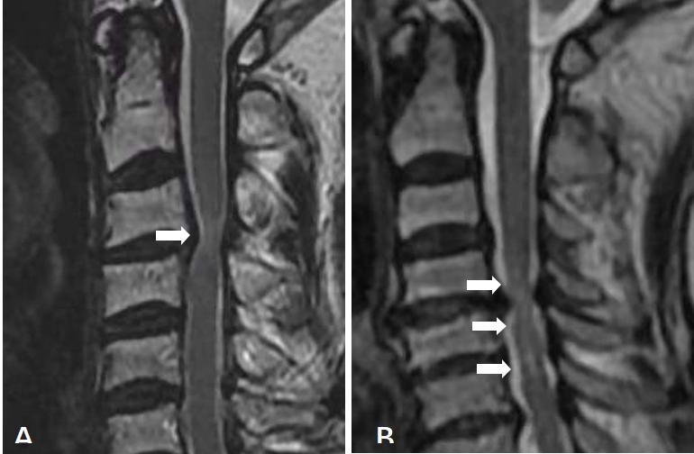 Correlation analysis of cervical kyphosis and spinal cord dysfunction ...