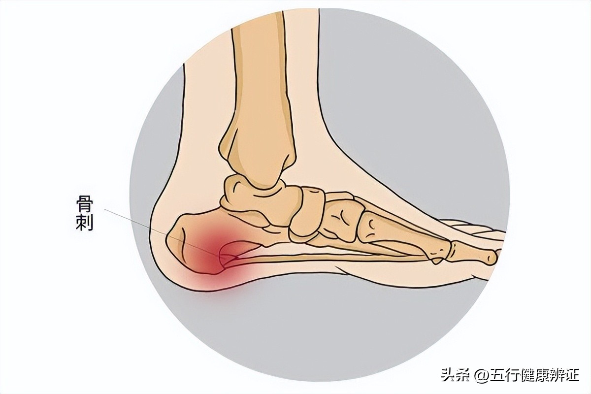 The heel dare not touch the ground, and the heel has a bone spur? Blind