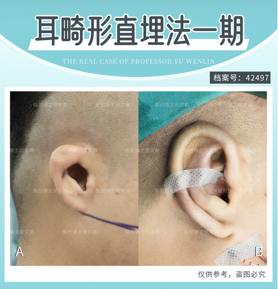 Why do ear reconstruction surgery need to be done in several stages ...
