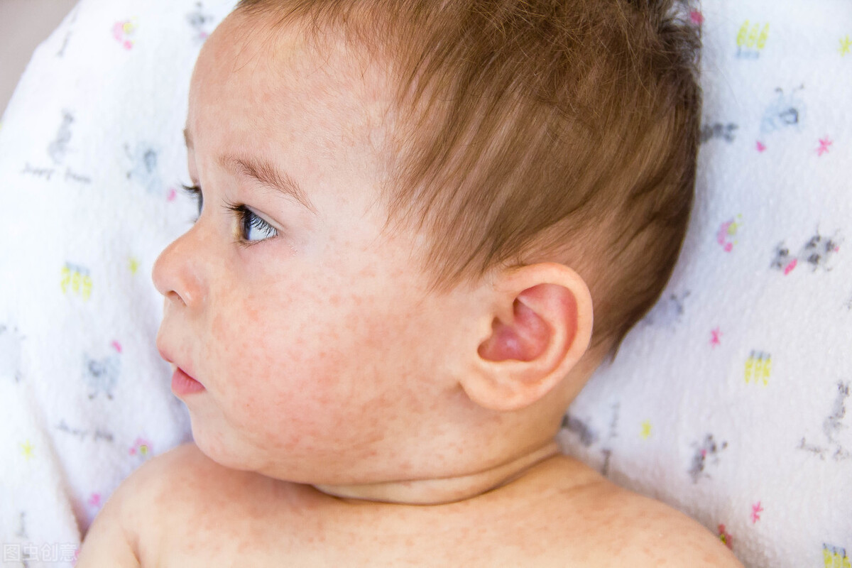 The baby's eczema has been repeated for so long. It turns out that the wrong method was used and