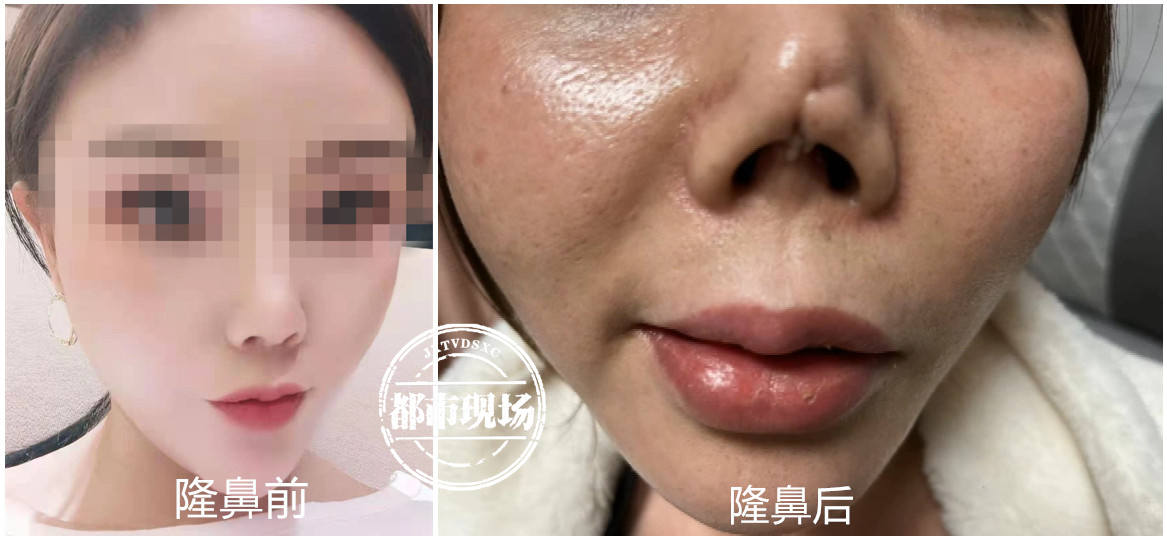 南昌:在"星禾荟医美"隆鼻失败 她说"像被老鼠啃了一大块肉"袁女士是在