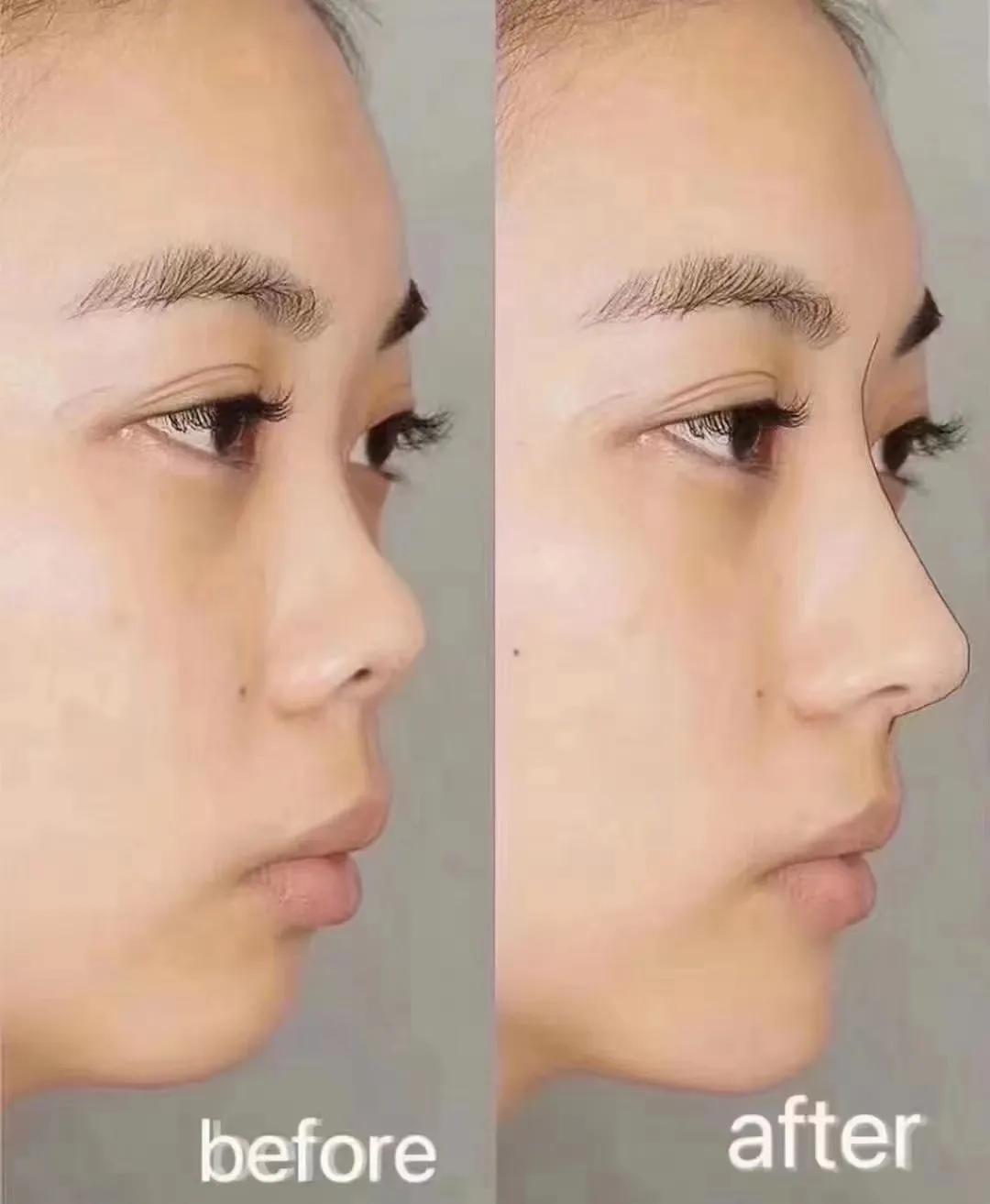 On the Importance of Nose?? and Chin iNEWS