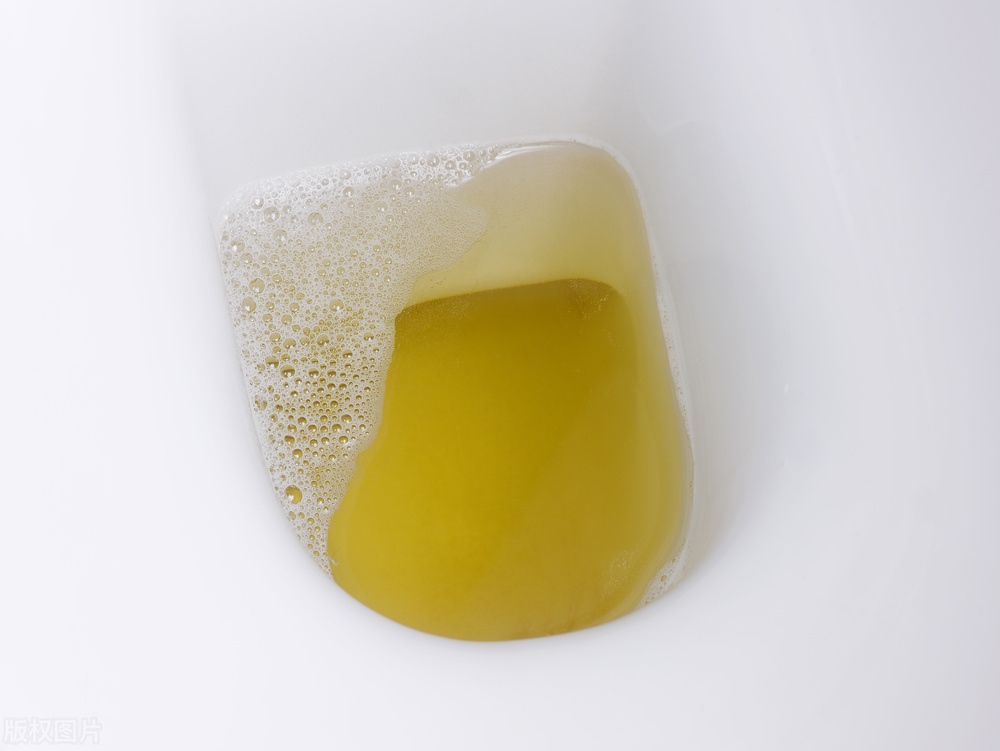 Does foamy urine cause kidney disease?distinguish these situations iNEWS