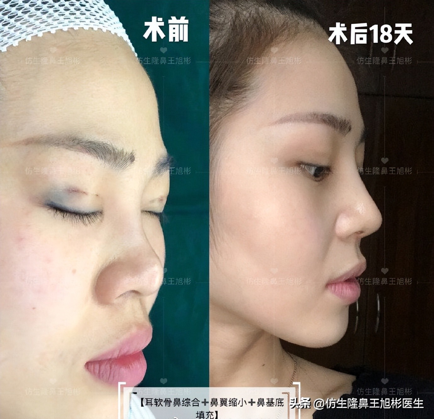 Applicable people and advantages and disadvantages of ear cartilage