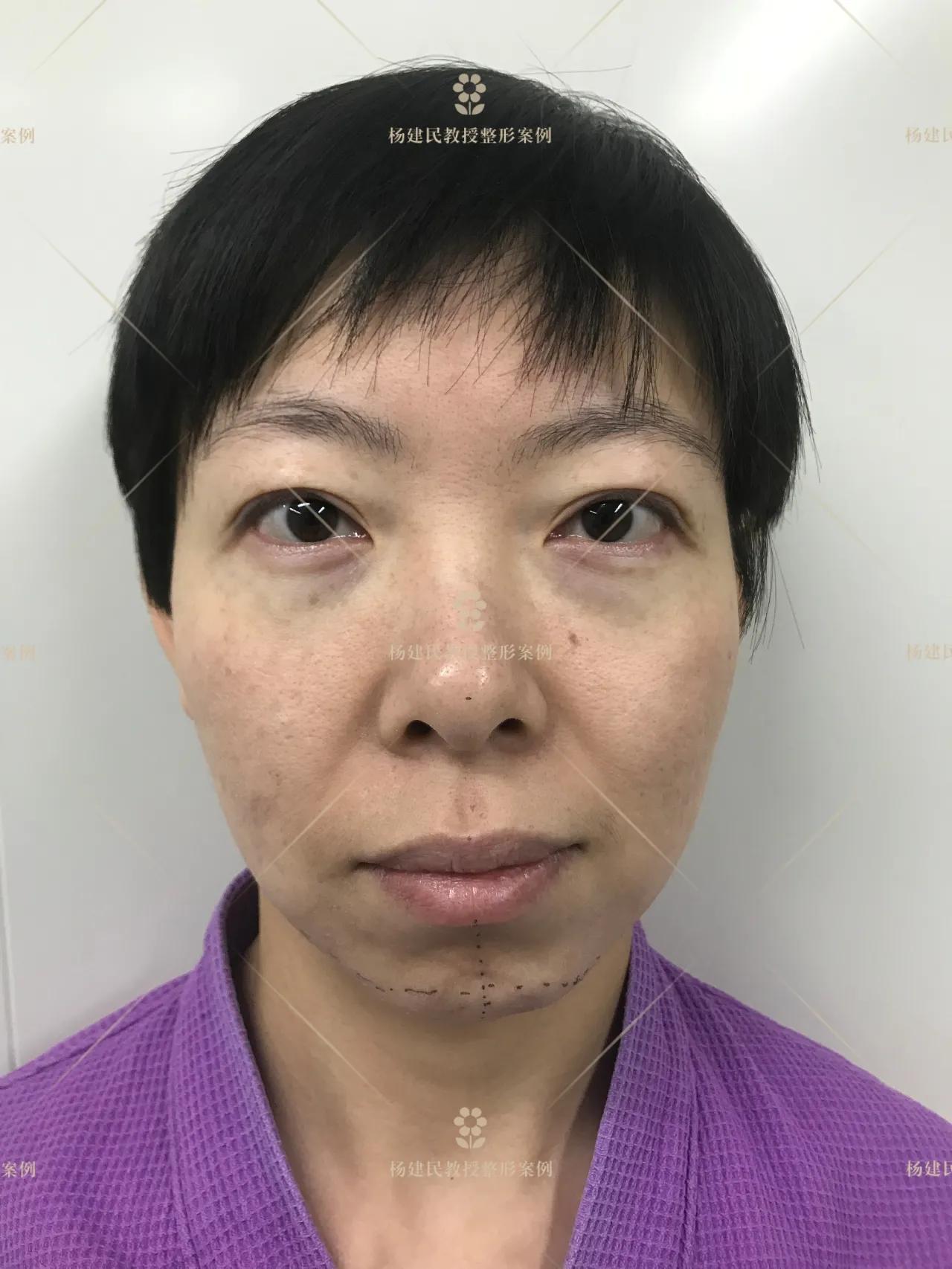 Autologous Fat Grafting for Facial Contouring iNEWS