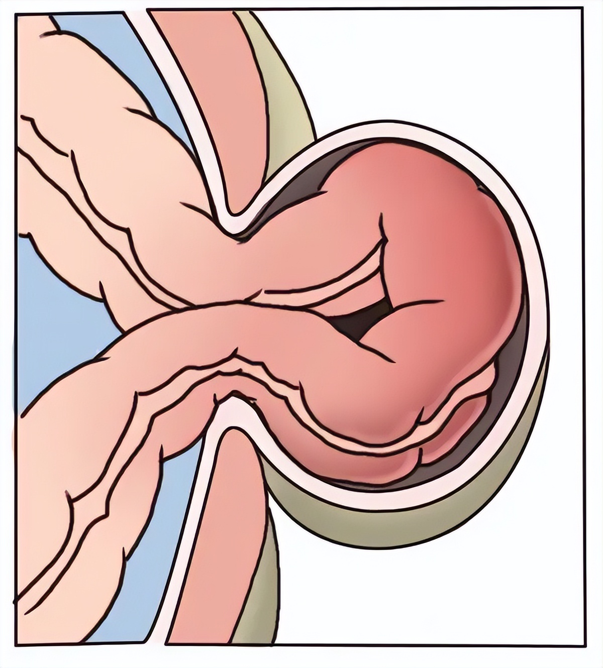 A 31-year-old man had abdominal pain and was diagnosed with ...