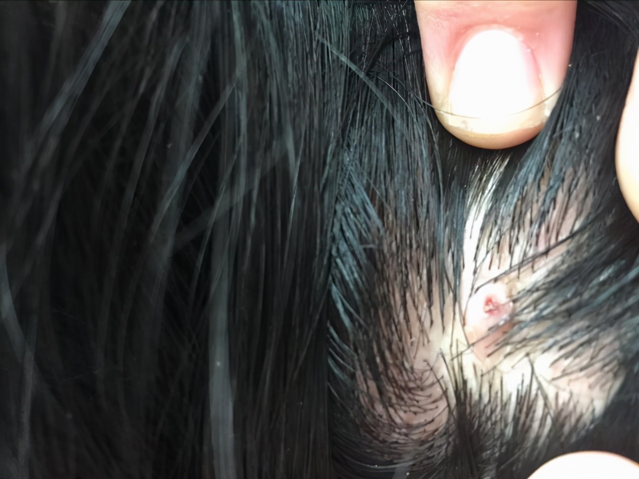 Why Do Pustules And Bumps Always Grow On The Scalp That May Be Related To These 4 Questions Inews