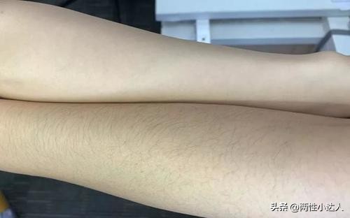 Why do some women have more body hair while others have less body hair ...