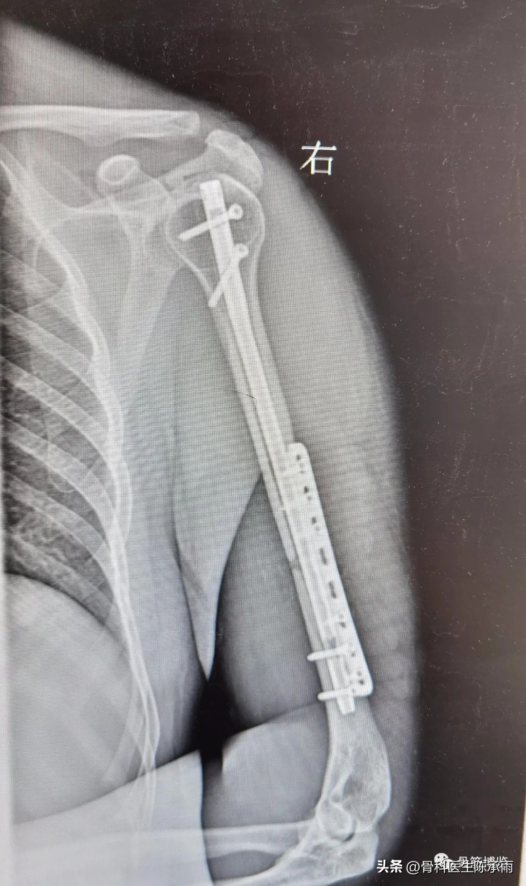 Internal fixation of humerus fractures with interlocking screws iNEWS