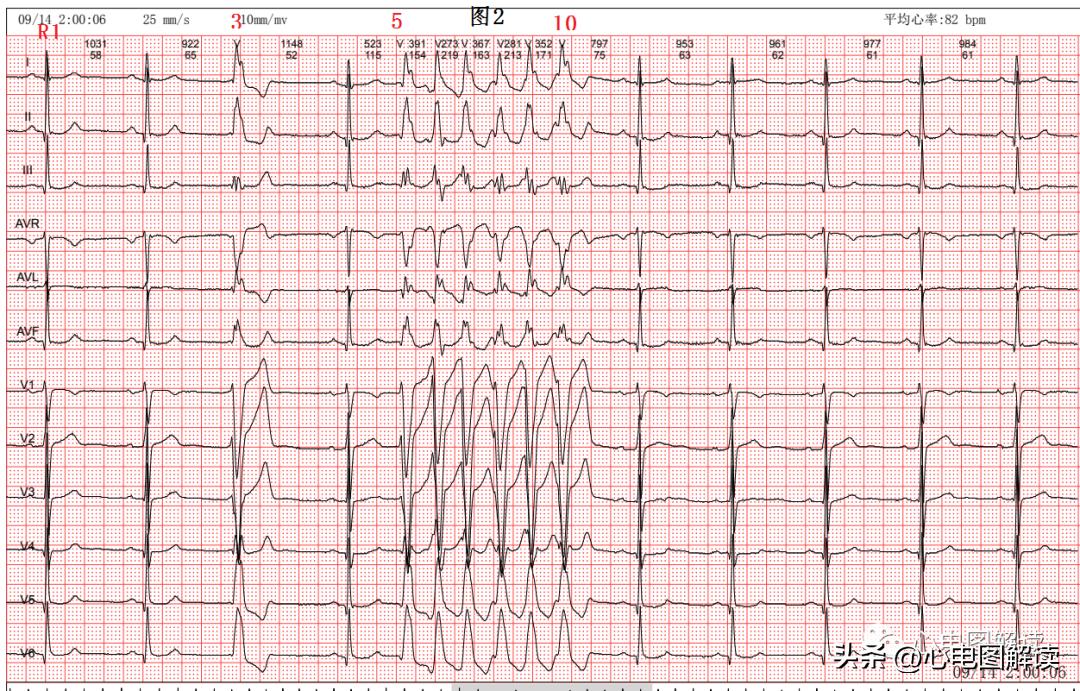 Arrhythmia In 2 Cases - INEWS