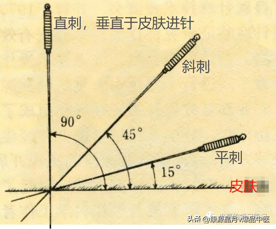 Acupuncture treatment for heel pain iNEWS