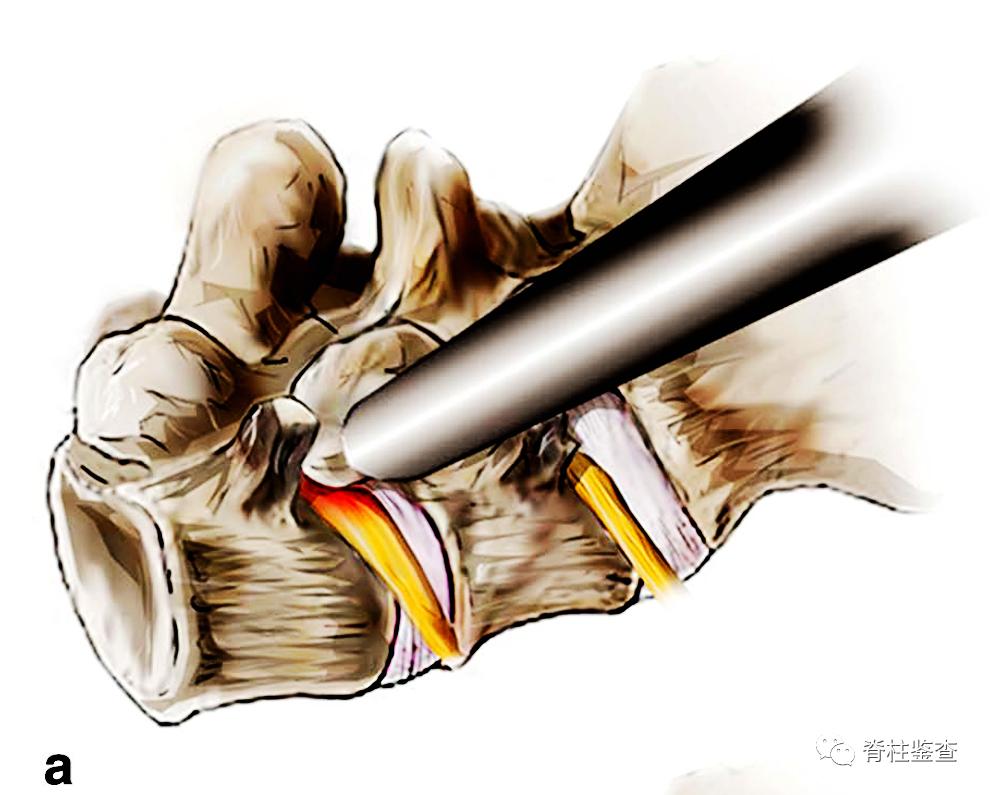 Percutaneous endoscopic lumbar foraminotomy what to do