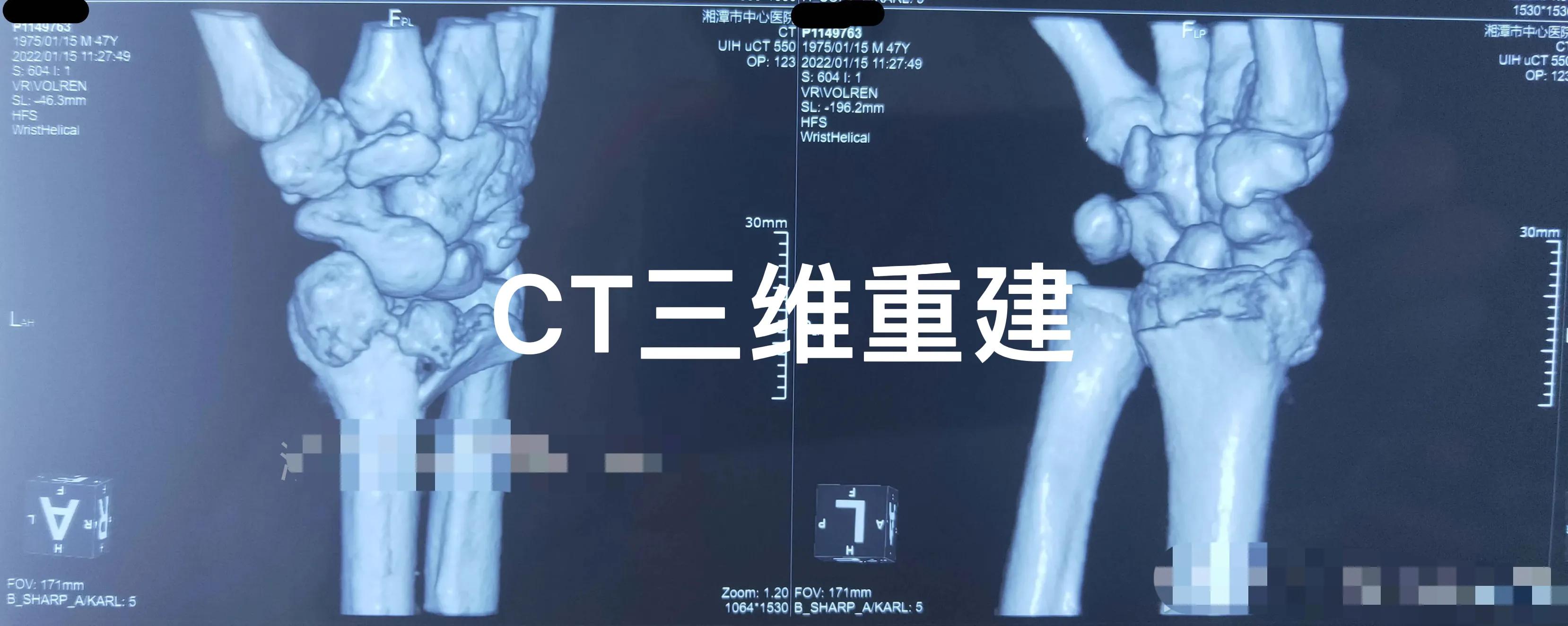 老年人腕部骨折手法复位石膏固定治疗方法指导 资讯咖