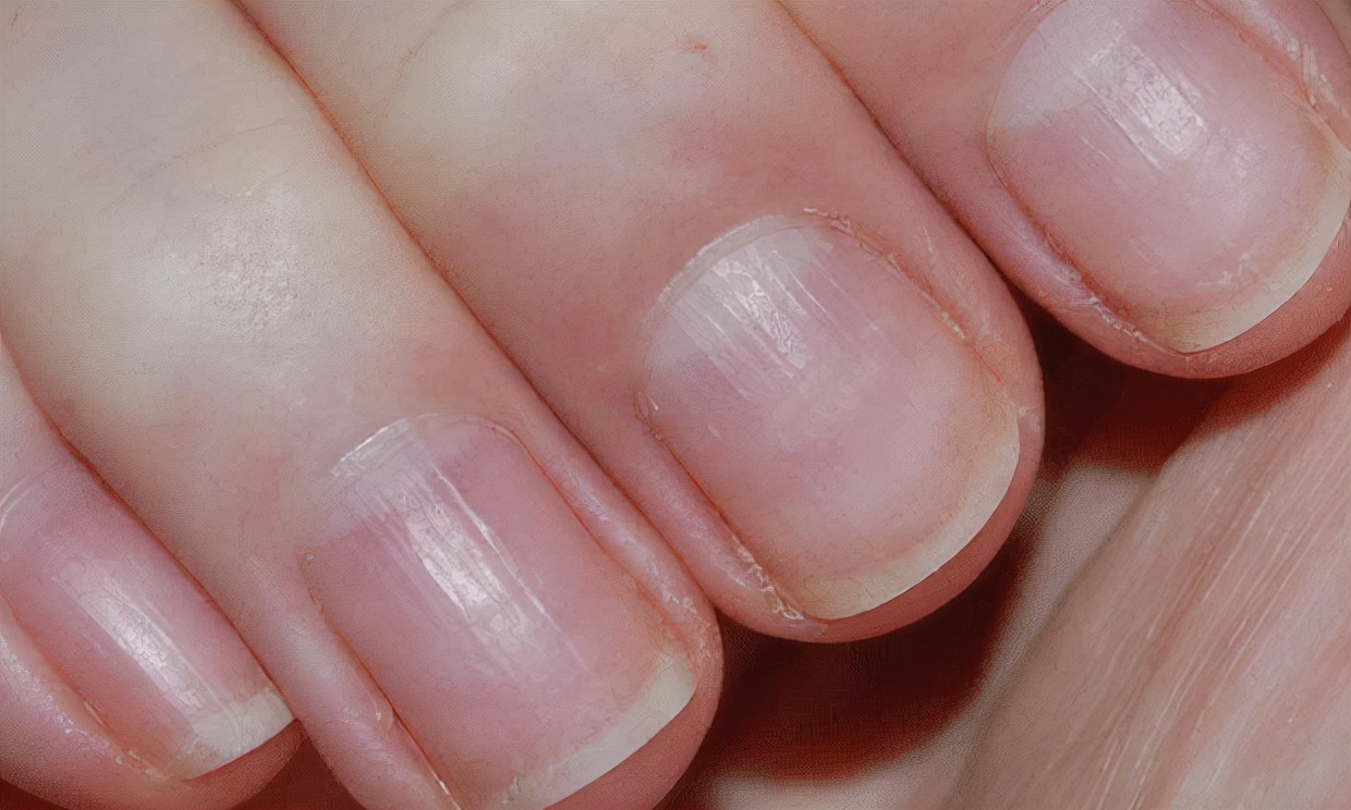 Vertical lines on nails are a sign of disease?About the secret of nails
