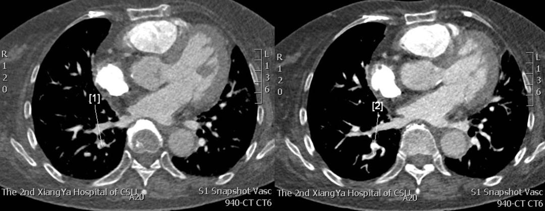 3 years of chest tightness, shortness of breath, edema of both lower ...