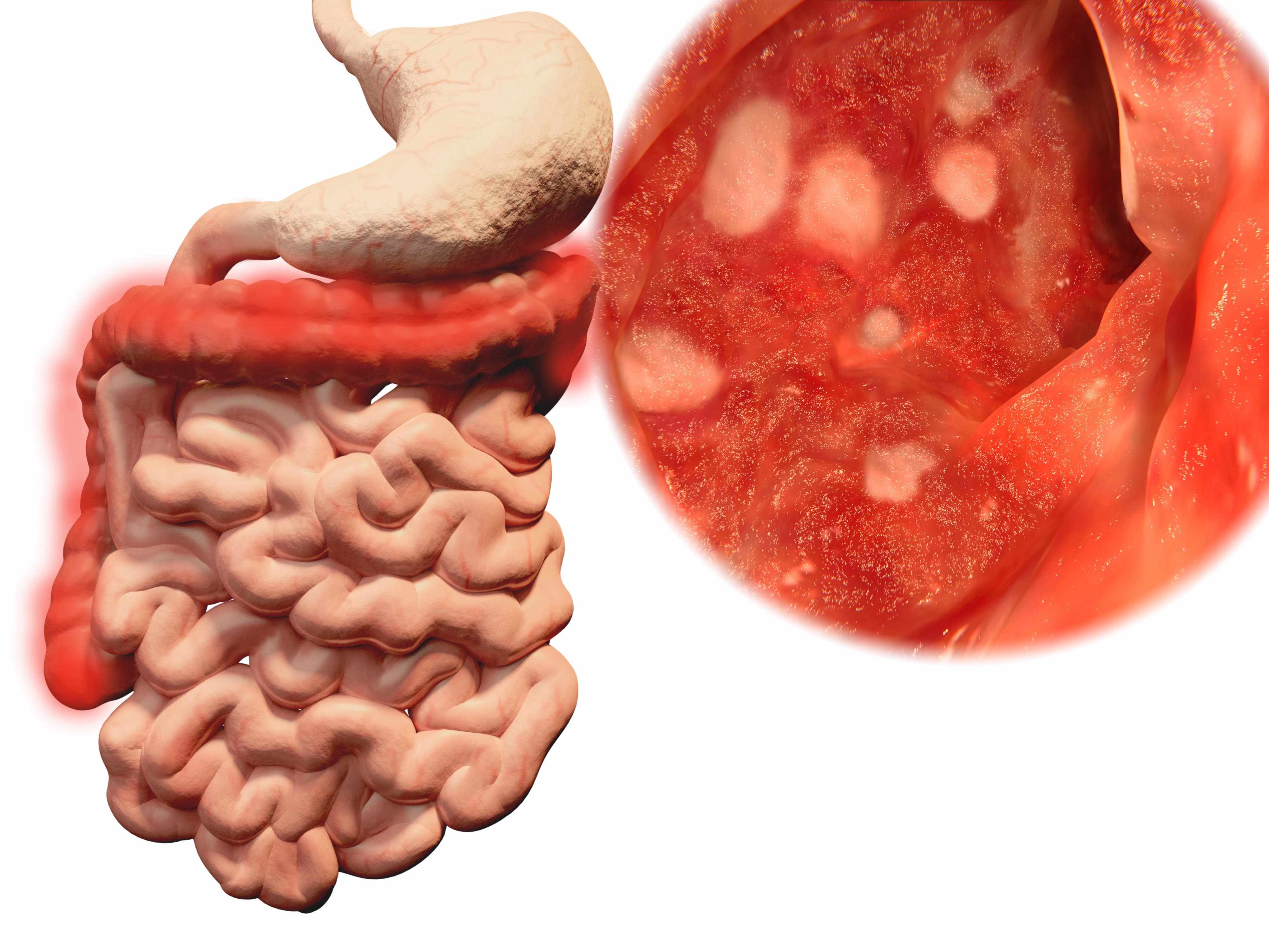 How long does a colonoscopy screening take what to do to prepare 