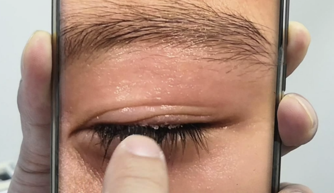 Accidentally splashed 502 into the eyes, and the cold water rinse made