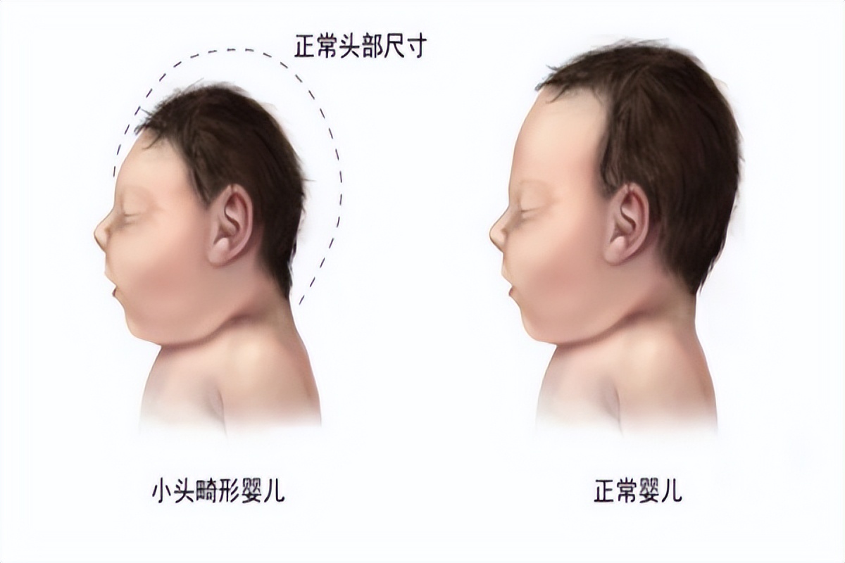 Is A Small Head Circumference A Microcephaly INEWS   745cadb7a1f743b8b41be54df7d1088c 