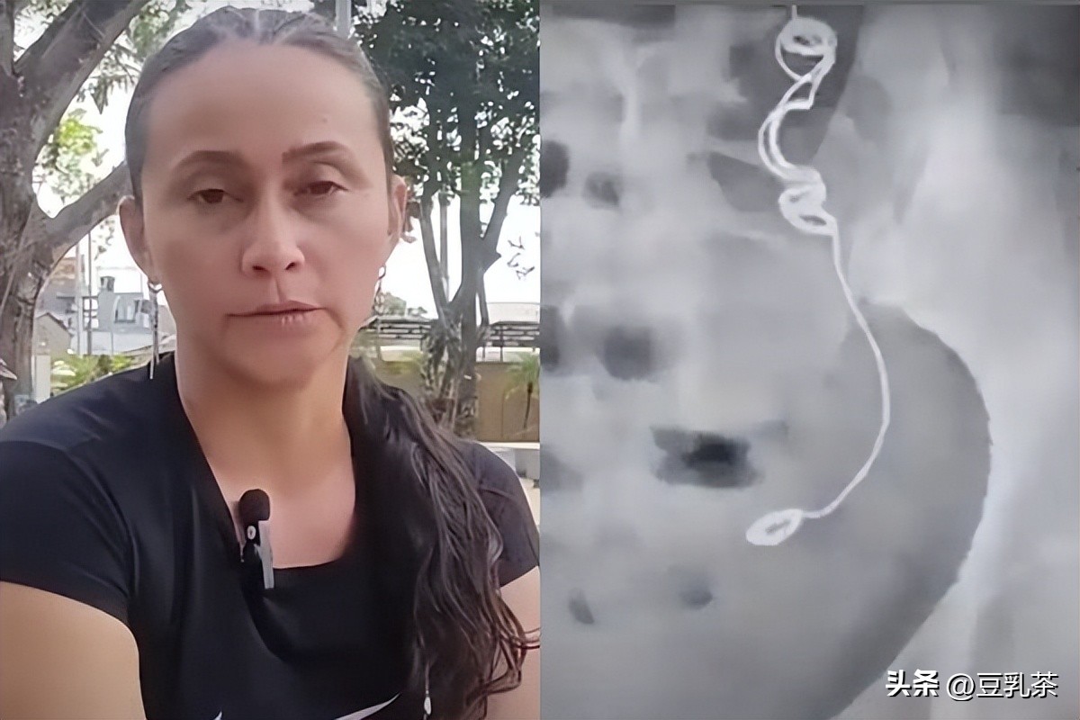 Fallopian tube ligation "Doctor to take out the needle and