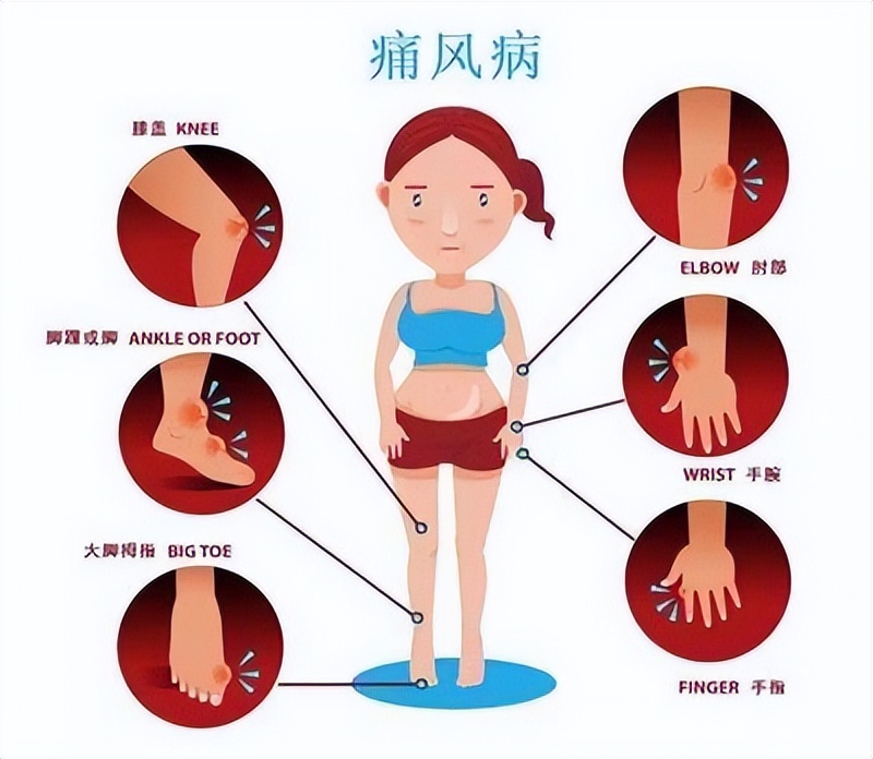 Elevated uric acid can cause gout attacks!Does not high uric acid mean