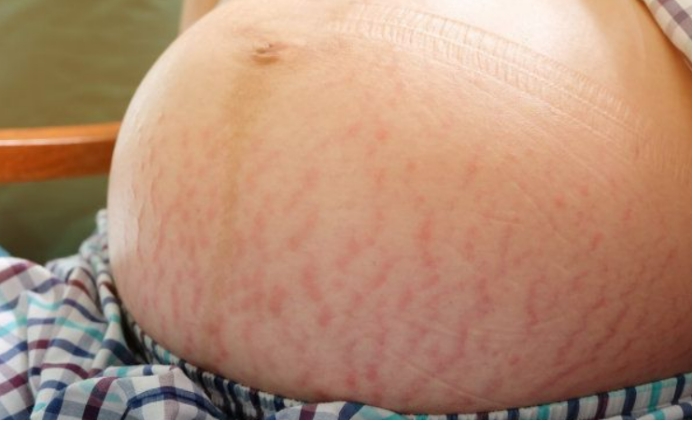The danger of being entangled in stretch marks can not only be itchy ...