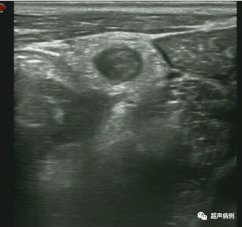 How does appendicitis look on ultrasound?What knowledge needs to be mastered?It's all summed up